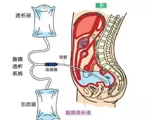 血透与腹膜透析，哪种方式对肾的损伤更大？