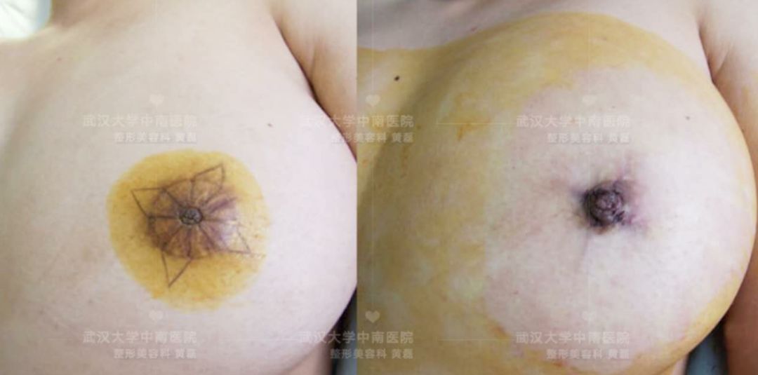 乳透变化，为何有时会变大并出现凹陷？